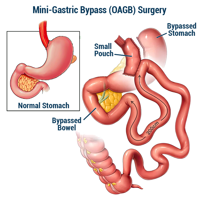 Gastric Bypass Surgery