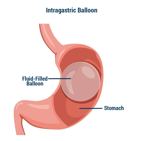 Intragastric Balloon