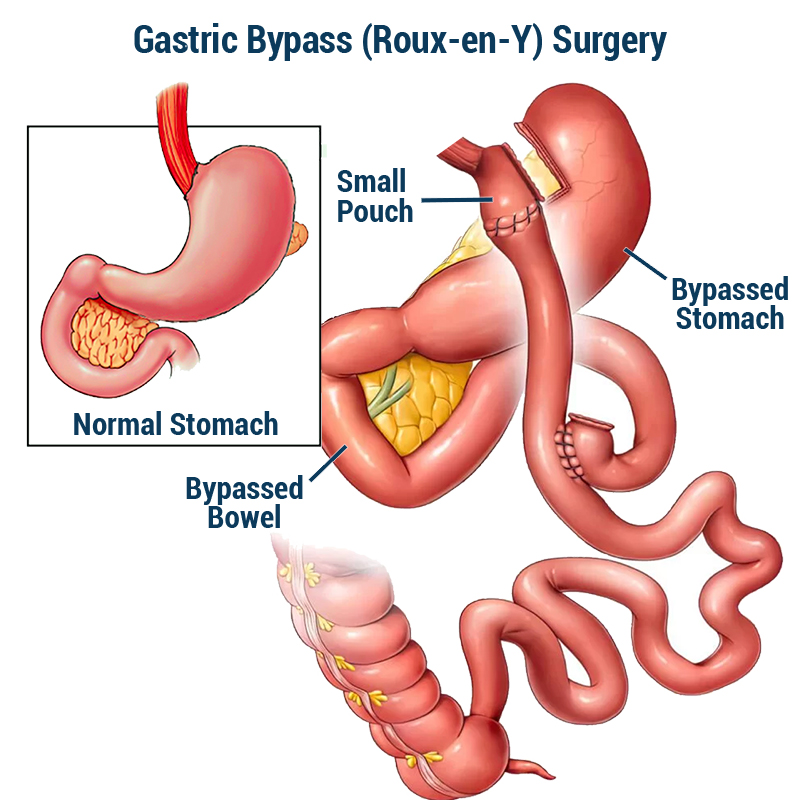 Gastric Bypass Surgery